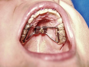 Dişleri Palatal genişleme çerçevesinde hastayla. Çocuğun birincil yaprak döken süt dişleri