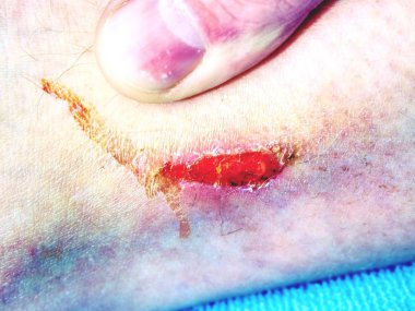 Taze etkilenen kanlı deri. Çürükler ve ıslak parçaları ile deride derin çizikler