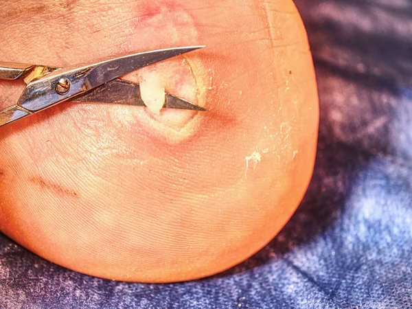 Cirurgião Corta Pele Morta Paciente Com Uma Tesoura Estéril Limpeza — Fotografia de Stock