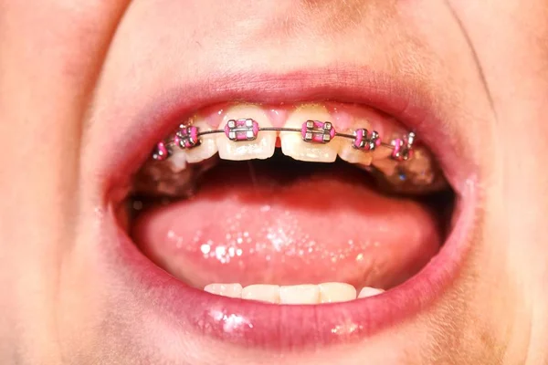 Νεαρό Αγόρι Δείχνει Σιδεράκια Δοντιών Ροζ Ελαστικός Λαβές — Φωτογραφία Αρχείου