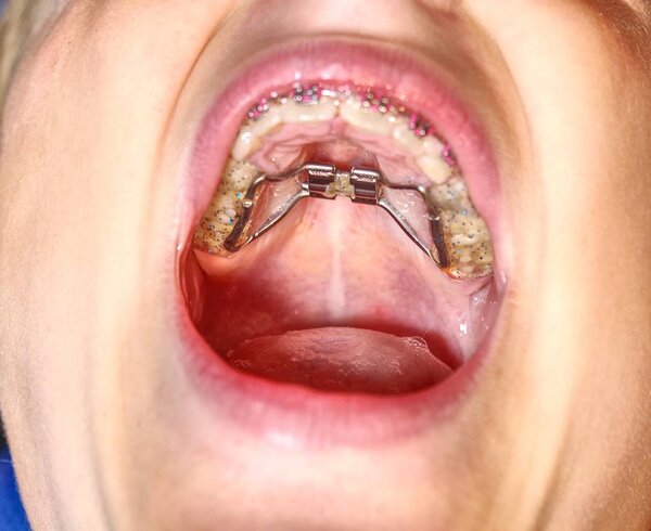 Hyrax rapid palatal expansion braces for thin jaw correction. Kid shows tooth frame braces. 