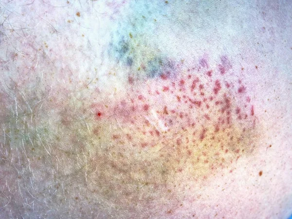 Large Bruise Wounded Man Leg Skin Laying Hospital Bed Colorful — Stock Photo, Image