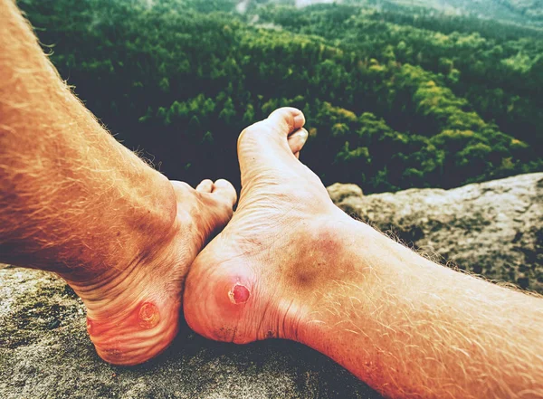 Hombre Excursionista Piernas Sudorosas Con Callo Doloroso Horrible Descansando Cima — Foto de Stock