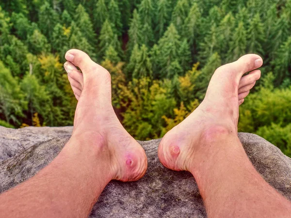 Close Blister Foot Male Hurt Hikers Legs Shoes Misty Morning — Stock Photo, Image