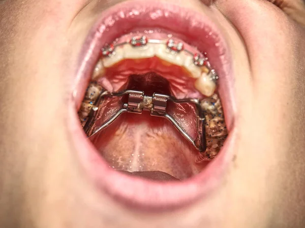 Frenos Dentales Boca Niño Adolescente Con Aparatos Ortopédicos Los Dientes — Foto de Stock