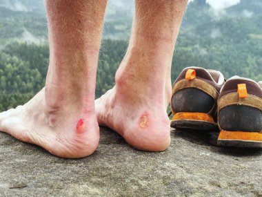 Injured rock climber heel stand on stone. Naked male legs with horrible blister on peak. Sandstone rock with tired hikers legs.  Misty morning climbing.  clipart
