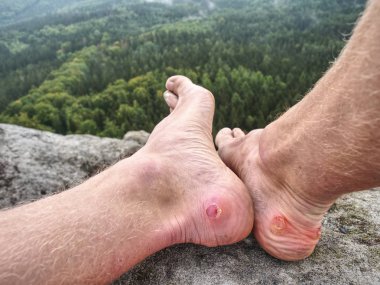Atlet iz runner dağlarda kalan al. Bacaklar kayalık arazide kanlı kabarcıklar ile spor shoesless bacaklar detay