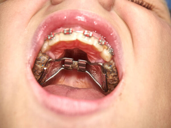 Рот с брекетами для зубов. Ортодонтия Методы зубной коррекции зубов (Bite). Приборы для расширения с помощью гирекса и склеивания

