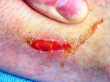 Cilt taze kanlı yerde. Kötü seyir bacak, detaylı atış çürük. Alçı içinde ambulancy kapsayan önce açık yara