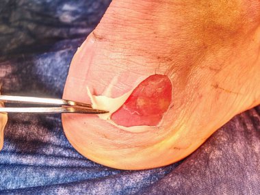 Spike makas, mavi steril arka plan ile hasta bacakta temizlik ölü deri hemşire. Çürükler ve ıslak parçaları ile deride derin çizikler