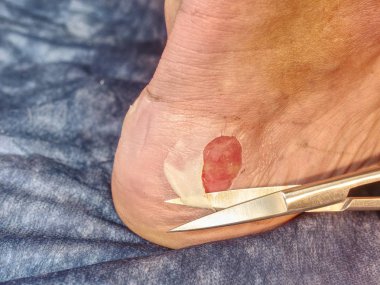 Harap Cilt Doktor eller tarafından Temizleme detay. Profesyonel yardım hastanede. Çürükler ve ıslak parçaları ile deride derin çizikler