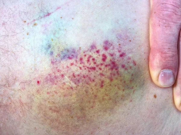 白色皮肤上有新的瘀伤 男性腿上的绿色紫色大瘀伤 人皮肤皮下损伤 — 图库照片
