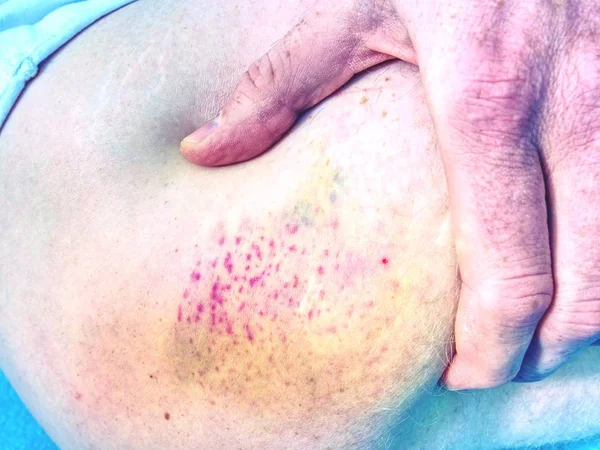 Fresh Bruise White Skin Painful Green Purple Huge Bruise Male — Stock Photo, Image