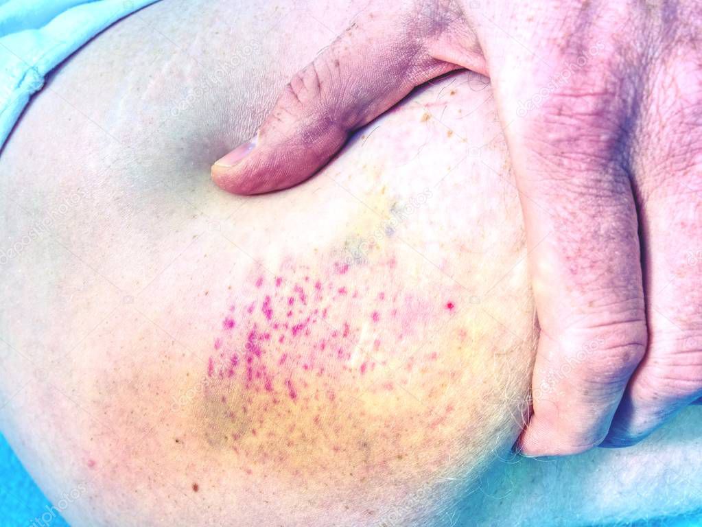 Fresh bruise on white skin.  Painful green purple huge  bruise on male leg.  The subcutaneous injury on human skin
