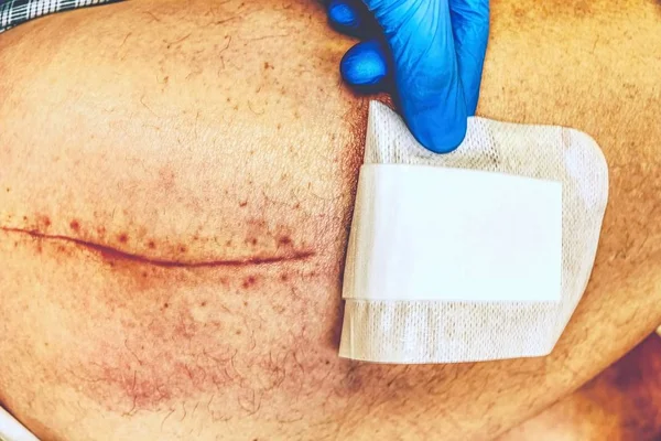 Pierna Humana Vieja Con Cicatriz Postoperatoria Cirugía Articular Cadera Detalle — Foto de Stock