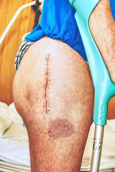 Old Human leg with postoperative scar of hip joint surgery.  Detail of skin with deep chirurgical cut. Health care in hospital.