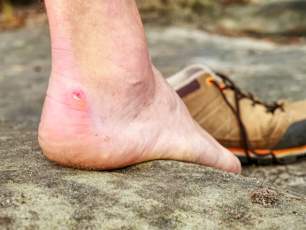 Close up on Blister on foot of a male. Hurt hikers legs without shoes. Misty morning fall nature. Outdoor activities