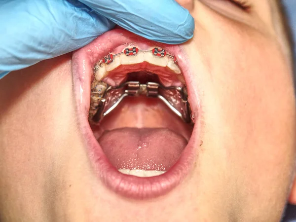 Praga República Checa Septiembre 2018 Paciente Con Frenos Dentales Durante —  Fotos de Stock