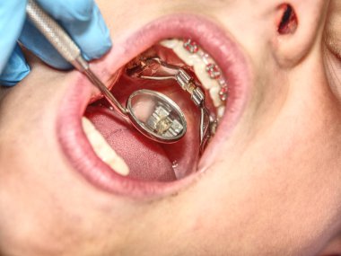 Prague, Czech Republic September 28th 2018. The Hyrax (Hygienic Rapid Expander) Banded designed as an upper arch rapid palatal expanding appliance. clipart