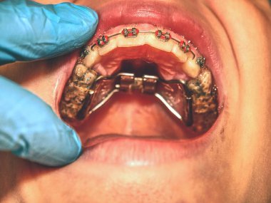 Prague, Çek Cumhuriyeti 28th Eylül 2018. Especial yüksek palatal parantez Doğum kusuru düzeltilmesi için. Makro çekim diş diş teli ile. Ortodontik tedavi. 