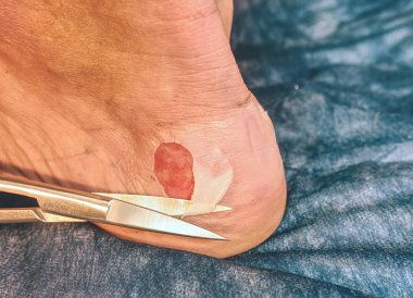 Yara kötü yandı. Yanmış deri Aşil tendonu, ekli yerden kaldırma. 