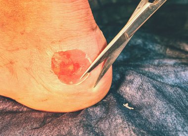 Aşınma topuk, spor ayakkabı çalışmasını harap cilt cilt üzerinde olan hastaya yardım hemşire