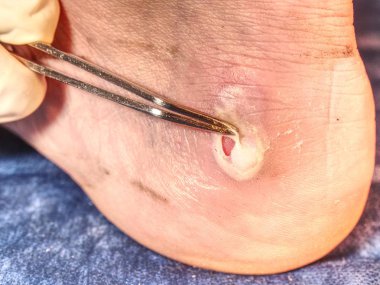 Mediciman tedavi sporcu topuk deride hasar. Aşil tendonu yakınındaki hasarlı cilt kötü sıcak yeri