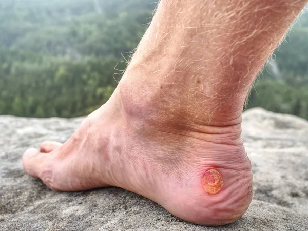 Atleta Corredor Trilha Descansar Nas Montanhas Pernas Com Bolhas Sangrentas — Fotografia de Stock