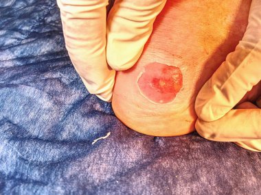 Spor kazadan sonra bacak üzerinde taze kanlı blister detayını. Erkek deri sıcak ve dokunulmaz bir yer. 