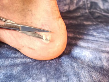 Aşınma topuk, spor ayakkabı çalışmasını harap cilt cilt üzerinde olan hastaya yardım hemşire