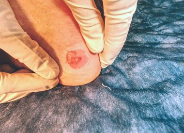 Yanlış botlar ve hastalar ayak deride yara enfeksiyonu blister. 