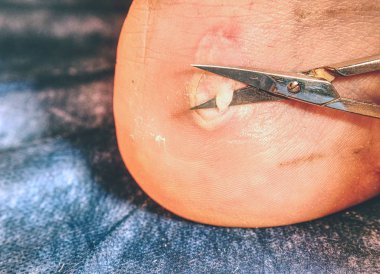 Yara kötü yandı. Yanmış deri Aşil tendonu, ekli yerden kaldırma. 