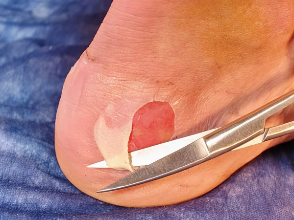 Doktor Ölü Deri Bacak Kesme Craced Korkunç Blister Insan Topuk — Stok fotoğraf