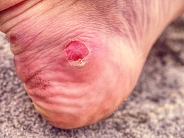 Acı ile çıplak ayak topuk doğada yara. Adam ayak 