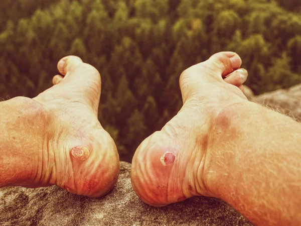 Pie desnudo con dolorosa herida de talón en la naturaleza. Hombre pies — Foto de Stock