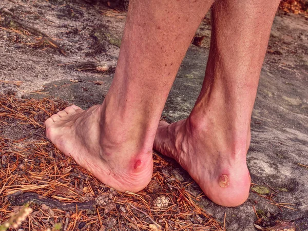 Pareja herida y piernas cansadas descansando en la cima de la montaña — Foto de Stock