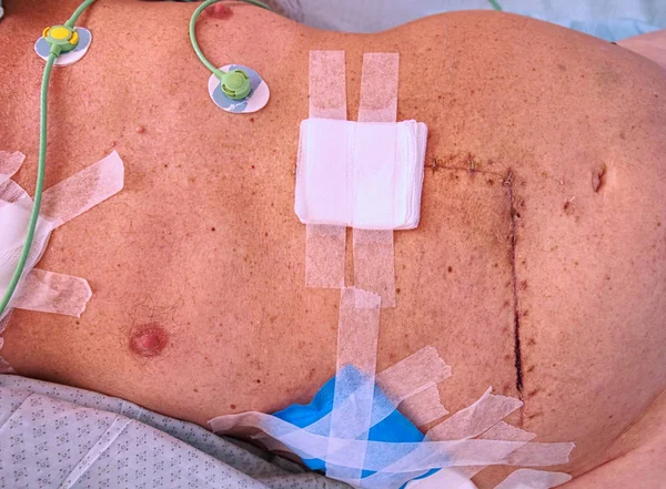 Paciente demuestra cicatriz fresca e ileostomía en el vientre — Foto de Stock