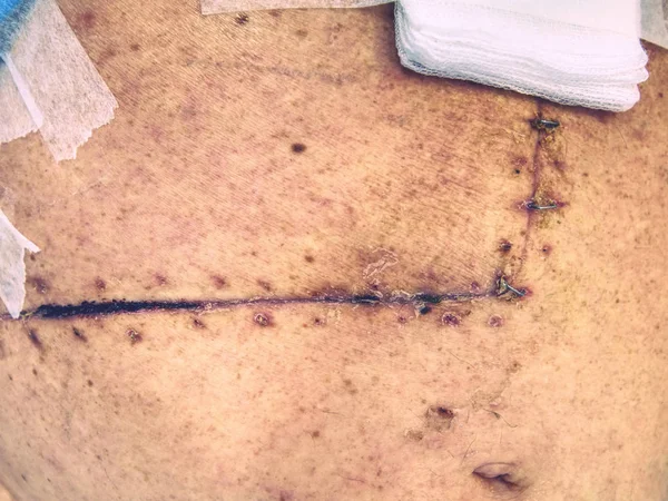 Медицинский шрам после операции на печени, удаление опухоли. Онкология, рак — стоковое фото