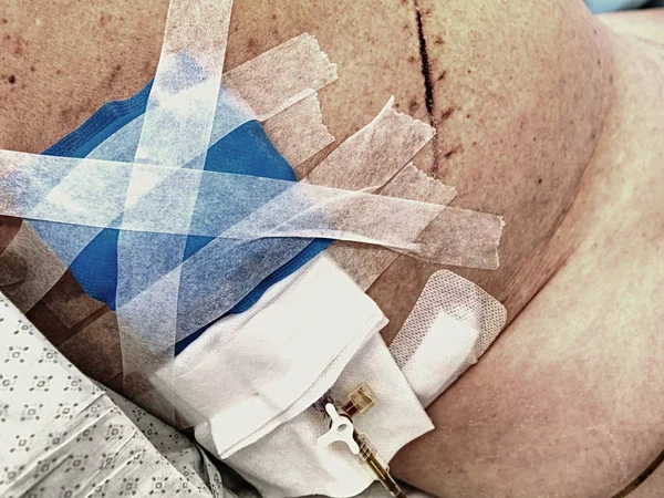 Cicatriz médica después de la cirugía hepática, extirpación del tumor. Oncología, cáncer — Foto de Stock