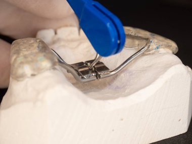 Diş teli ayarı ayrıntıları. Hyrax hasta dişleri için diş tellerini genişletir. Hastaların üst damak alçısının ön dişlerinde doğuştan gelen kusurlar var.