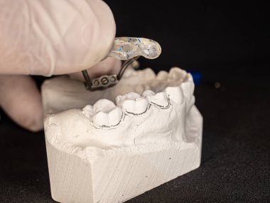 Üst çene kemiği için palatal genişletici, test ayarlanıyor. Üst çeneyi daha geniş yapmak için çıkarılabilir ortodontik cihaz. Dar çeneli çocukları tedavi etmek için sıklıkla kullanılır
