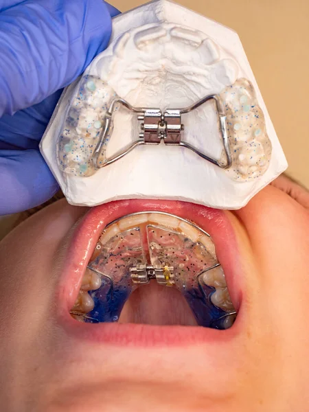 Médico Verificar Retentor Correção Ortodôntica Boca Métodos Correção Dos Dentes — Fotografia de Stock