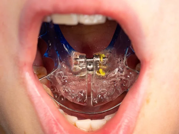 Muestra Frenos Acrílicos Con Alambre Inoxidable Lengua Colocación Aparatos Ortopédicos — Foto de Stock