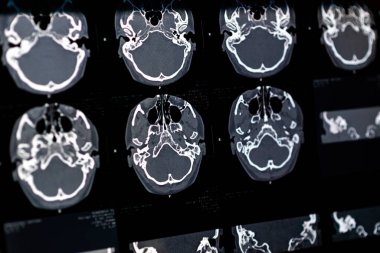 Beyin CT taraması x-ray filmi veya hesaplanmış tomografi görüntüsü Beyin