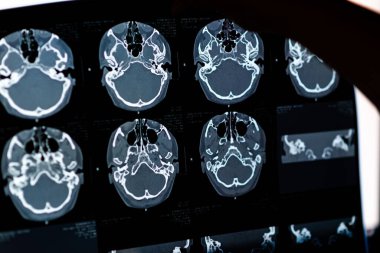 Beyin CT taraması x-ray filmi veya hesaplanmış tomografi görüntüsü Beyin