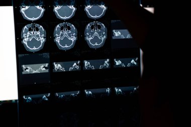 Beyin CT taraması x-ray filmi veya hesaplanmış tomografi görüntüsü Beyin