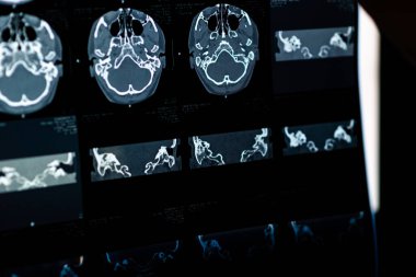 Beyin CT taraması x-ray filmi veya hesaplanmış tomografi görüntüsü Beyin