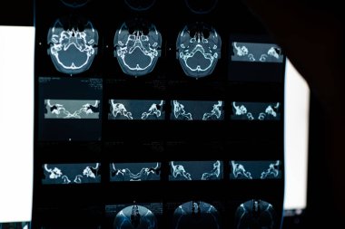 Beyin CT taraması x-ray filmi veya hesaplanmış tomografi görüntüsü Beyin