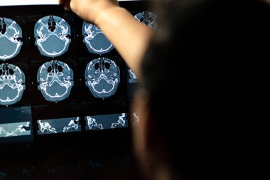 Beyin CT taraması x-ray filmi veya hesaplanmış tomografi görüntüsü Beyin