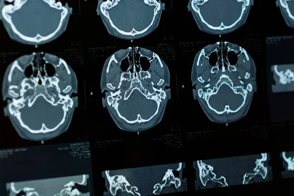 Beyin CT taraması x-ray filmi veya hesaplanmış tomografi görüntüsü Beyin